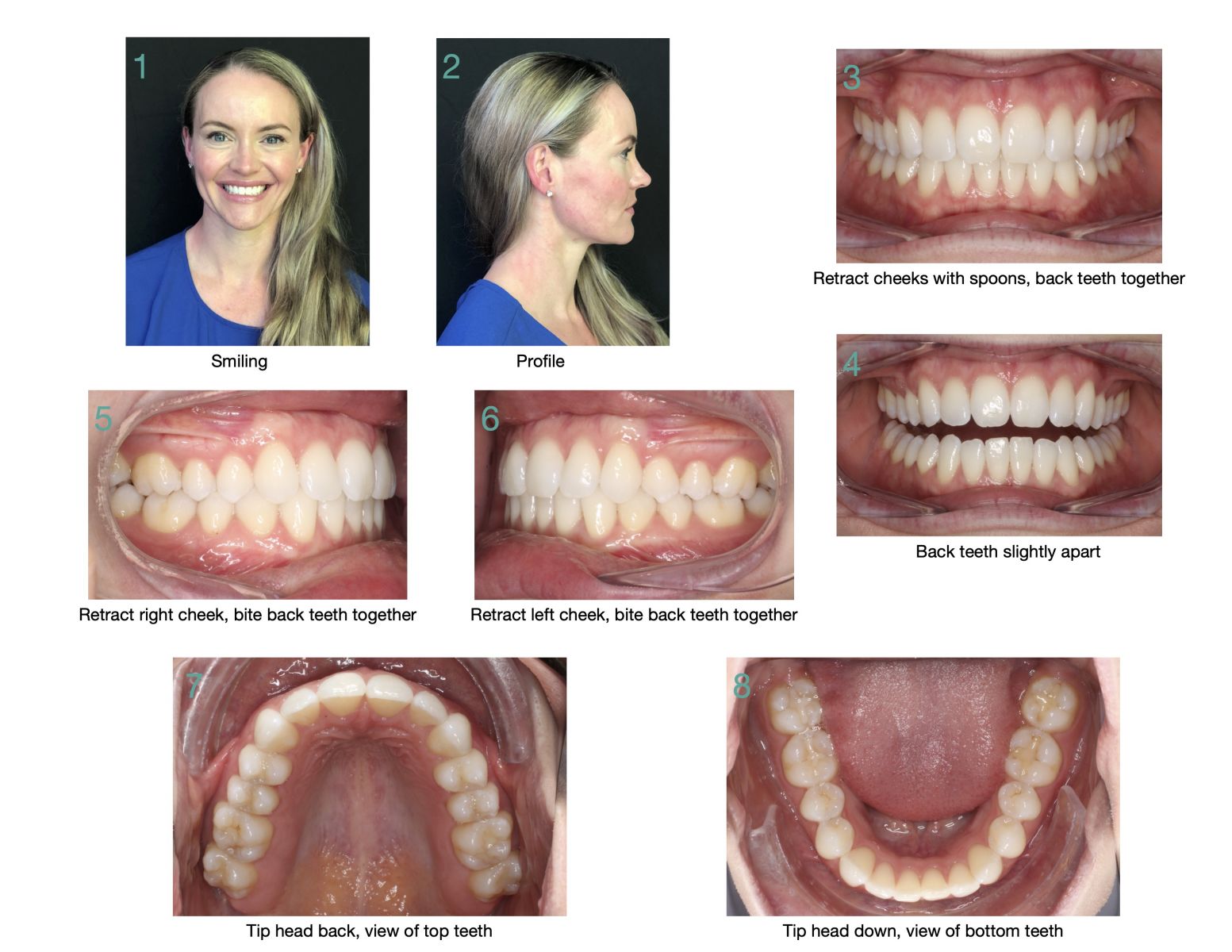 Virtual Consultation Baird Orthodontics Pleasanton CA